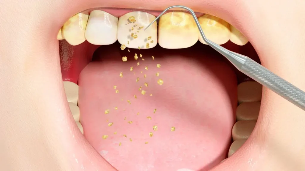 dentes sendo limpos por um equipamento manual de um médico dentista