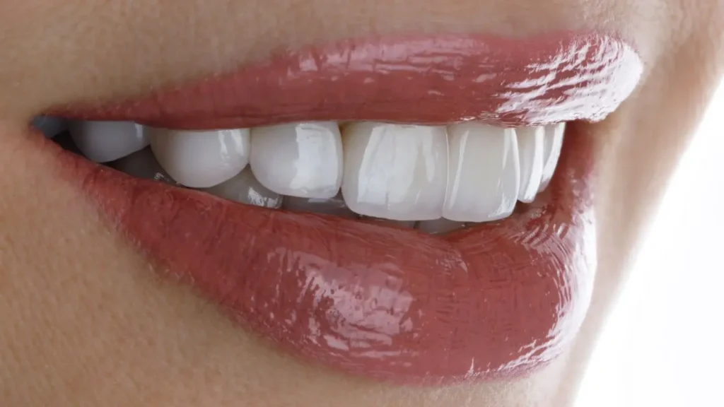 paciente com os dentes brancos após o procedimento de colocação de facetas de resina nos dentes