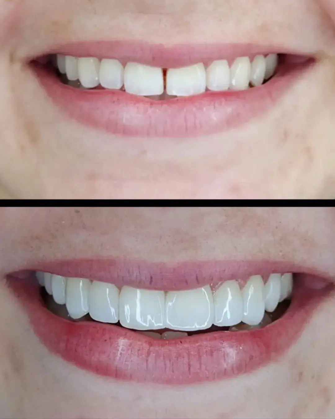dentista em camaçari especialista em facetas de resina composta
