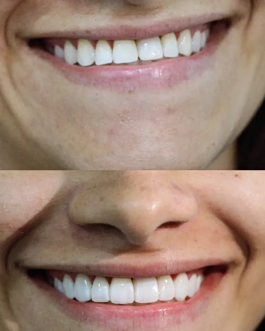 resultado das facetas de resina que foram feitas na clínica