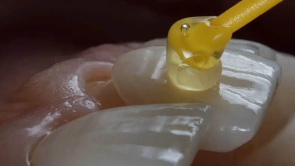 colocação de facetas de resina nos dentes do paciente