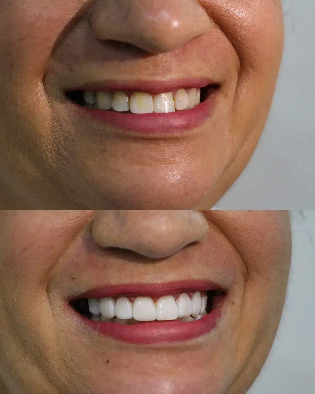 facetas de resina antes e depois