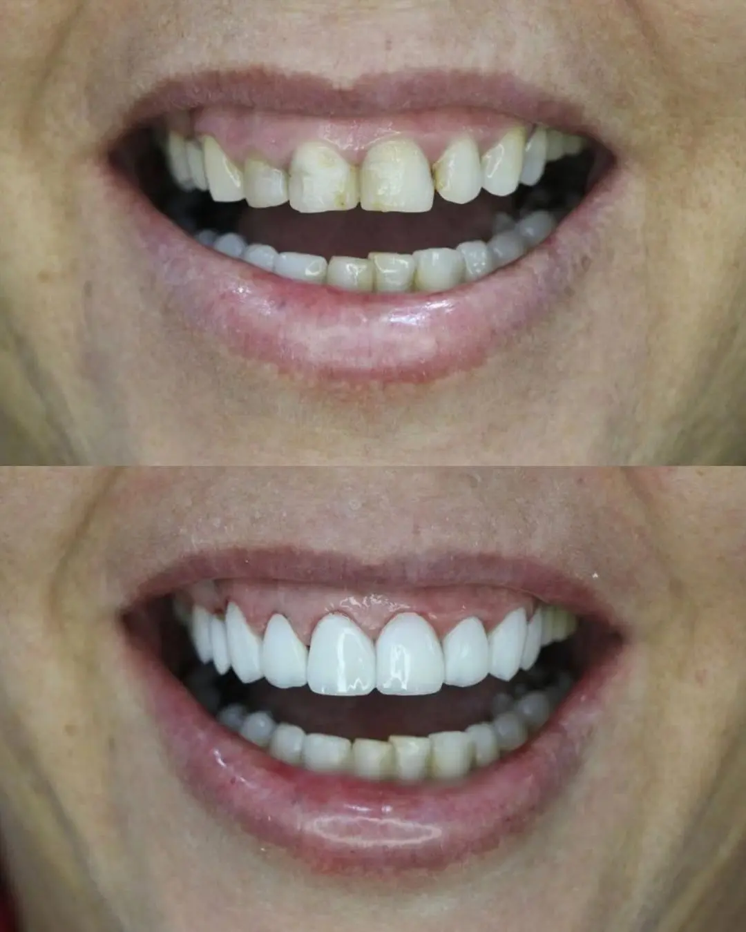 antes e depois dos resultados de um procedimento feito no dentista em camaçari, Dr Lucas Mota