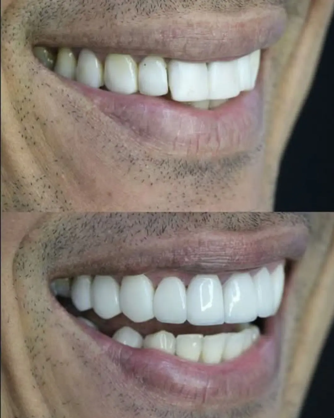 dentes brancos e saudáveis pos procedimento estético com um dentista em camaçari