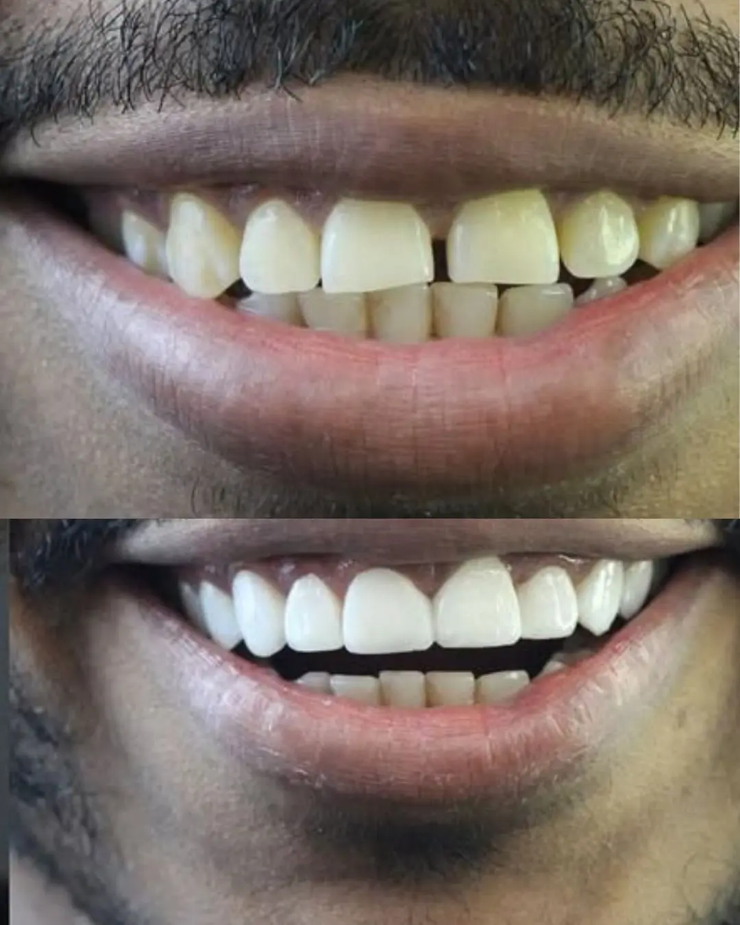 resultado após um procedimento estético de facetas feita no dentista em camaçari, Dr Lucas Mota