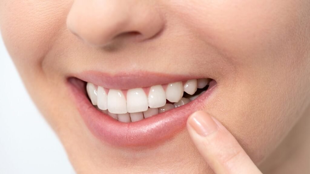 foto da boca de uma paciente logo após ela ter feito o processo completo de facetas de resina