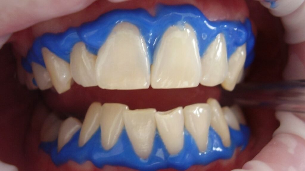 dentes de um paciente iniciando o tratamento do clareamento dental
