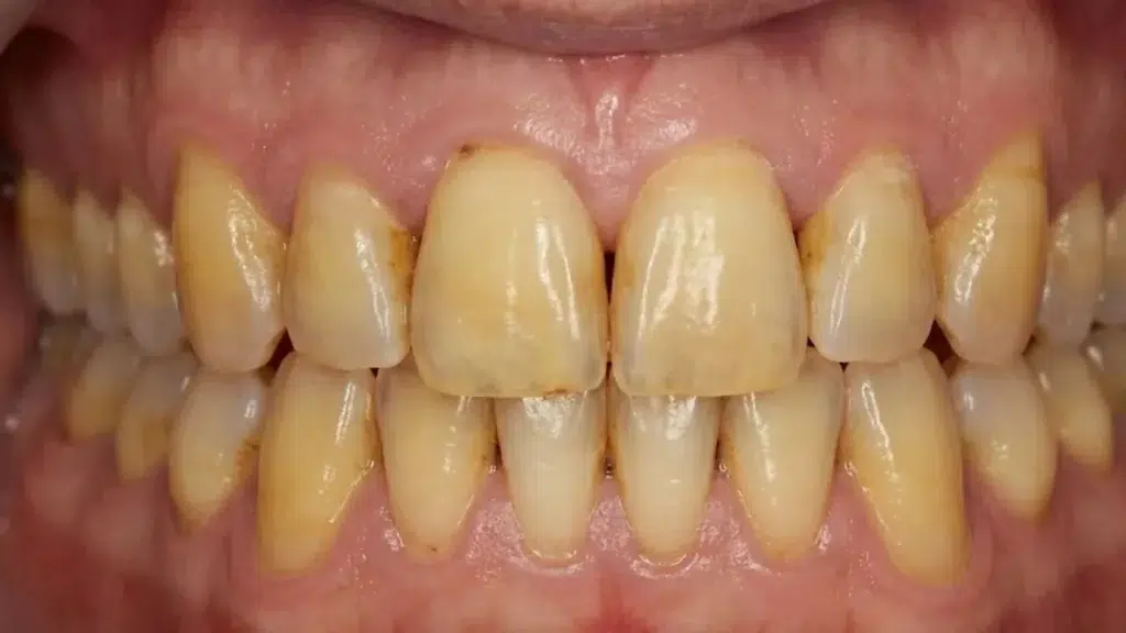 dentes amarelados de um paciente