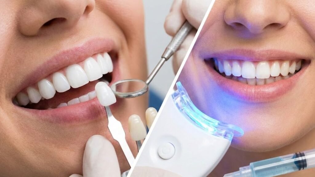 preparação e algumas diferenças entre facetas de resina e clareamento dental