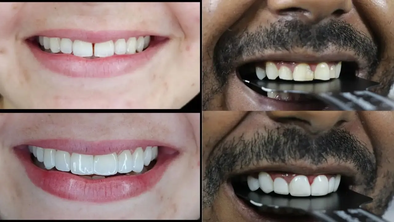 pacientes que passaram pelo procedimento de colocação de facetas de resina em meu consultório de Salvador