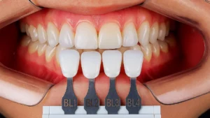 paciente com a boca aberta prestes a colocar facetas de resina nos dentes