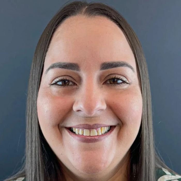 antes-facetas-resina