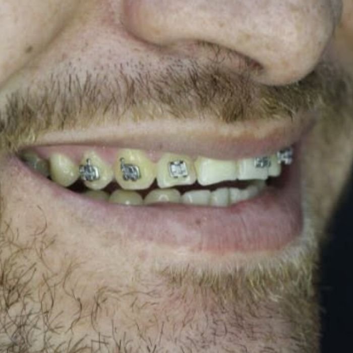 sorriso antes de colocar as lentes de contato dental