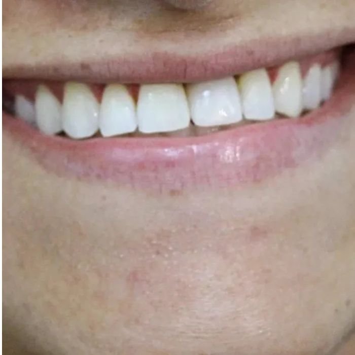 sorriso da nossa paciente que veio na clínica para colocar suas facetas de resina