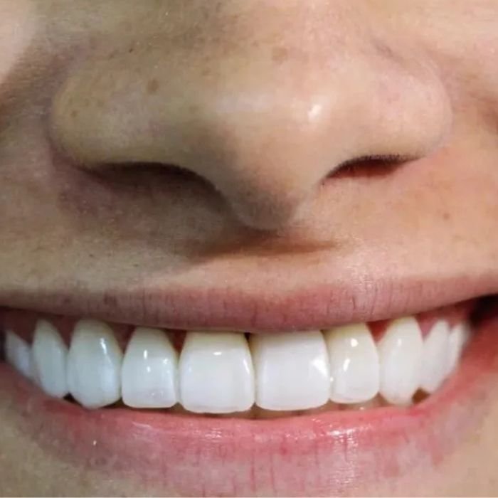 camacari-foto-de-sorriso-depois-de-colocar-as-facetas