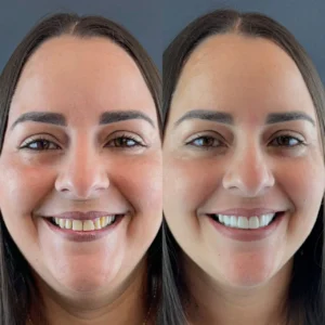 paciente com antes e depois de fazer o procedimento de facetas de resina com o Dr Lucas Mota, dentista em Camaçari