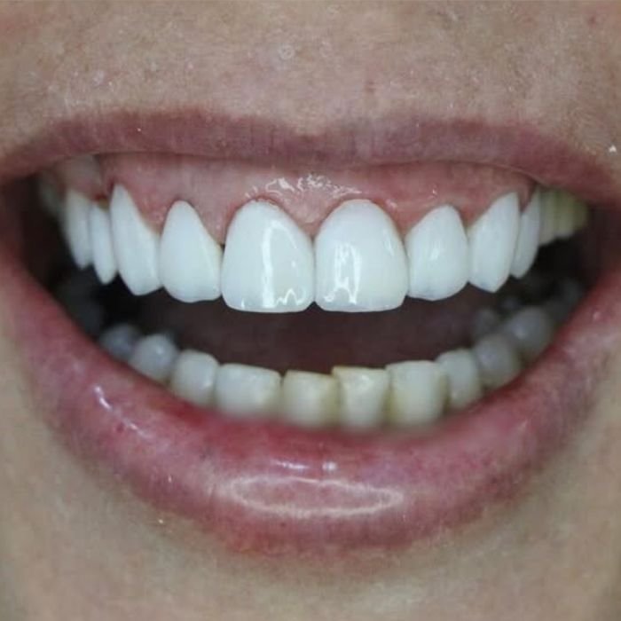 depois das facetas de resina