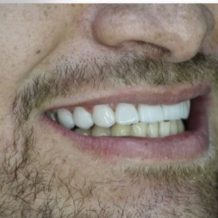 sorriso depois de ter colocado as lentes de contato dental