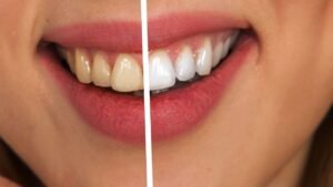 imagem da boca de uma paciente que colocou facetas de resina
