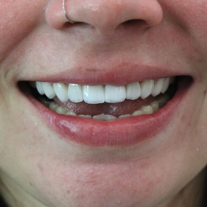 resultado do procedimento depois de colocar as facetas de resina