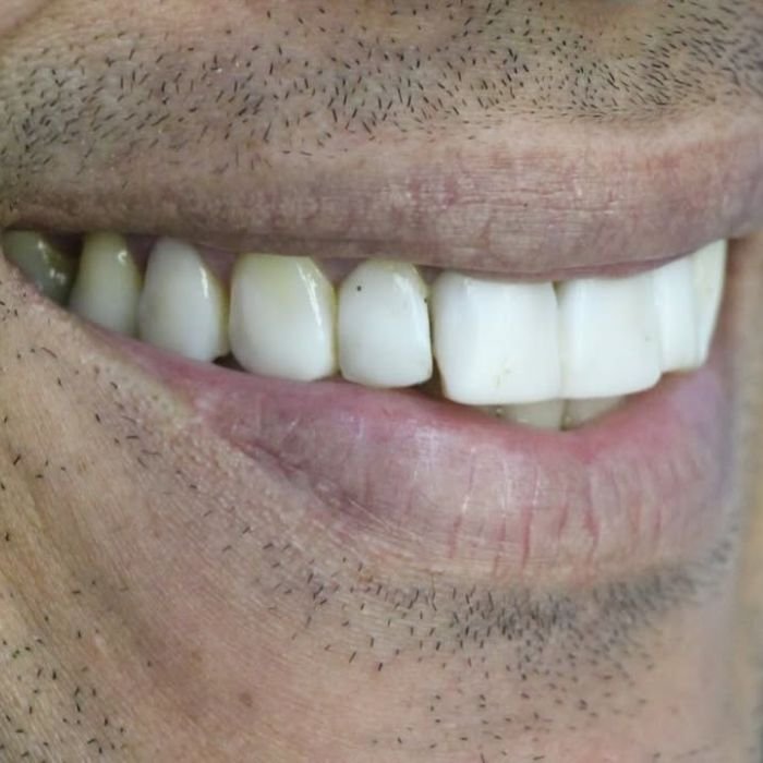 sorriso do paciente antes de colocar as facetas de resina