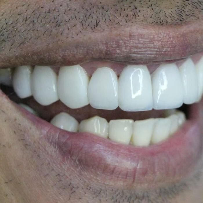 sorriso do paciente depois dele ter colocado as facetas de resina