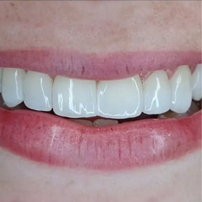 sorriso dela depois de ter colocado as facetas de resina