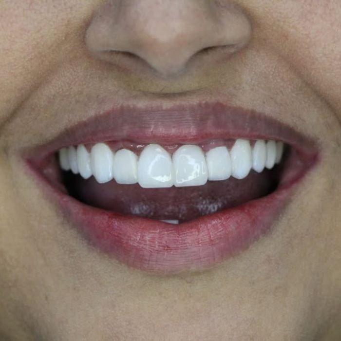 resultado incrível depois de colocar as facetas de resina
