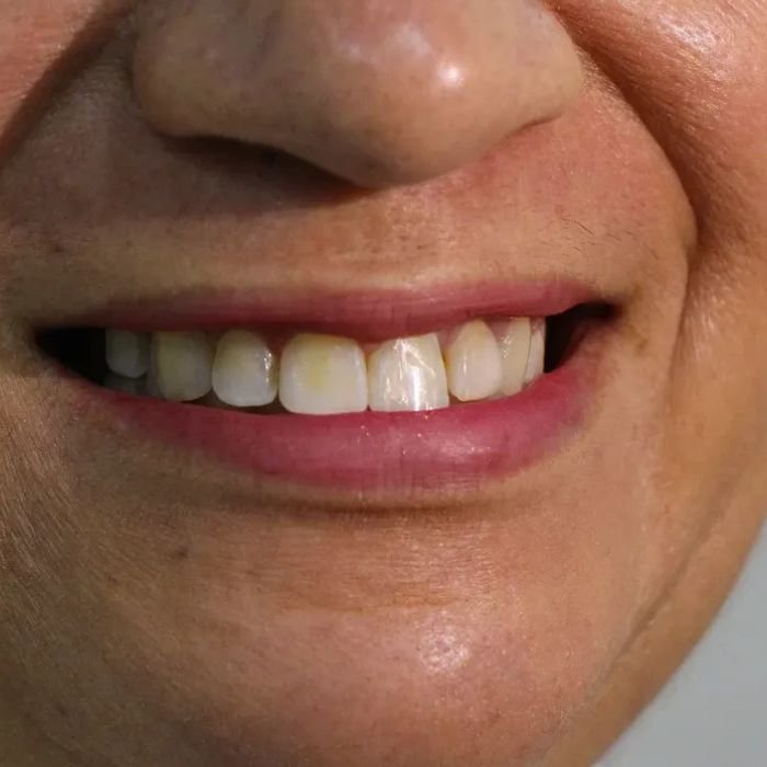 sorriso de uma das nossas pacientes antes dela ter decidido colocar lentes de contato nos dentes