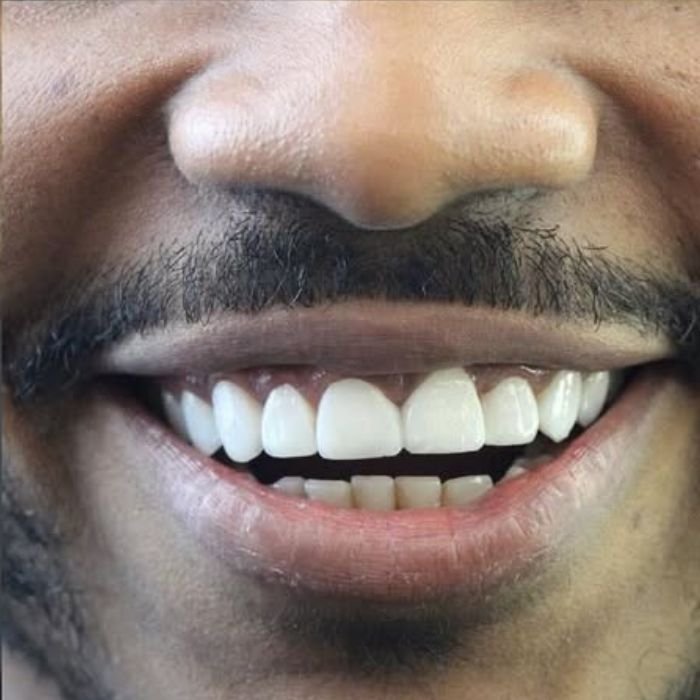 depois de ter colocado as facetas de resina o resultado é que os dentes dele voltaram a ficarem juntos