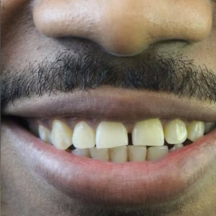 paciente tinha dentes separados antes do procedimento de colocação das facetas de resina