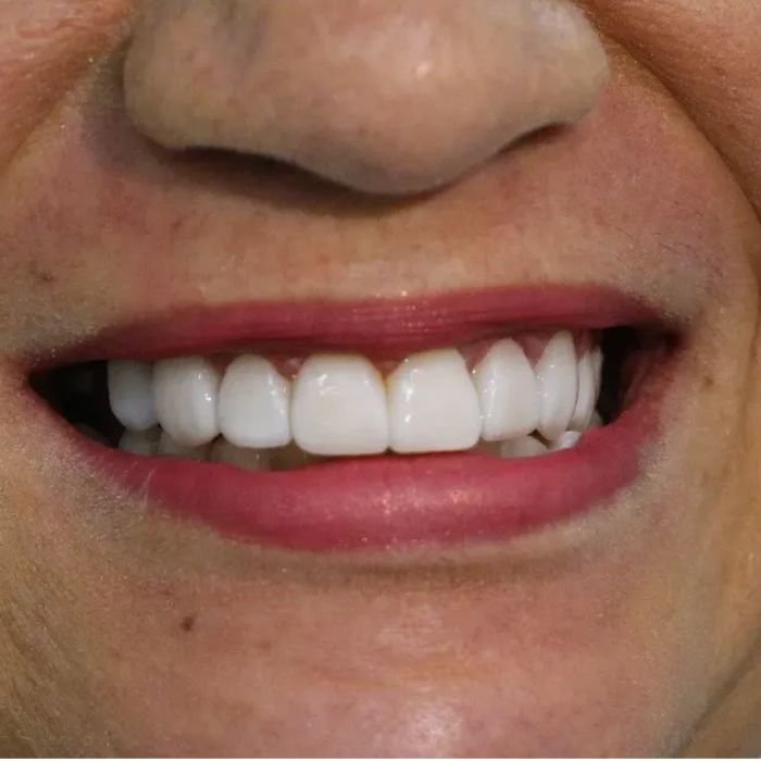 lindo sorriso após a colocação das lentes de contato
