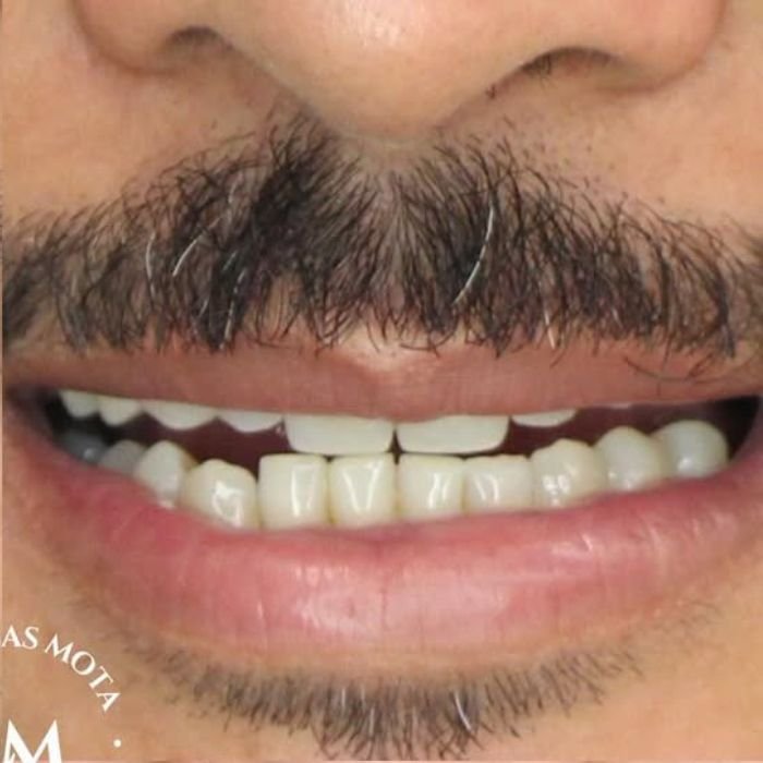 foto tirada de um paciente dando um sorriso fechado antes de colocar as facetas de resina
