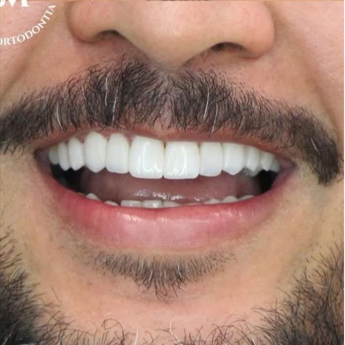 foto do sorriso fechado do paciente logo depois de termos colocado as facetas de resina