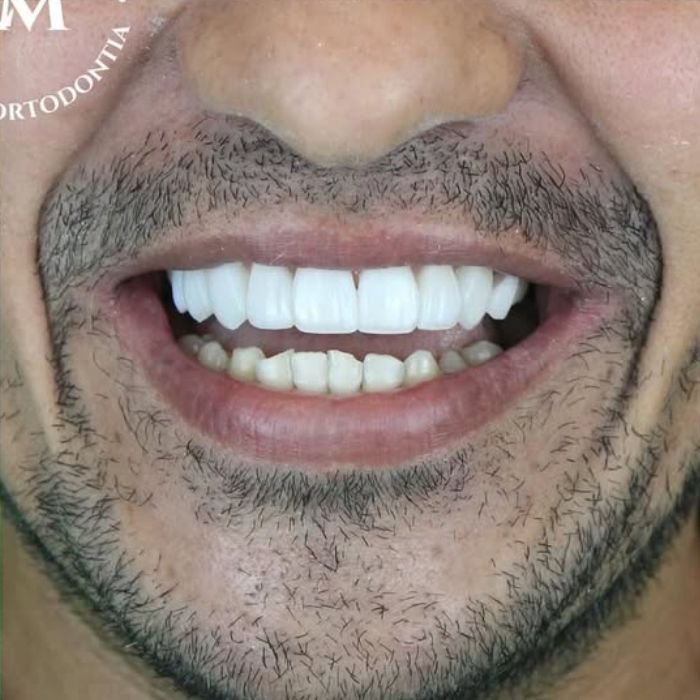 dente depois de ter colocado faceta de resina