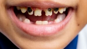 criança com dente podre