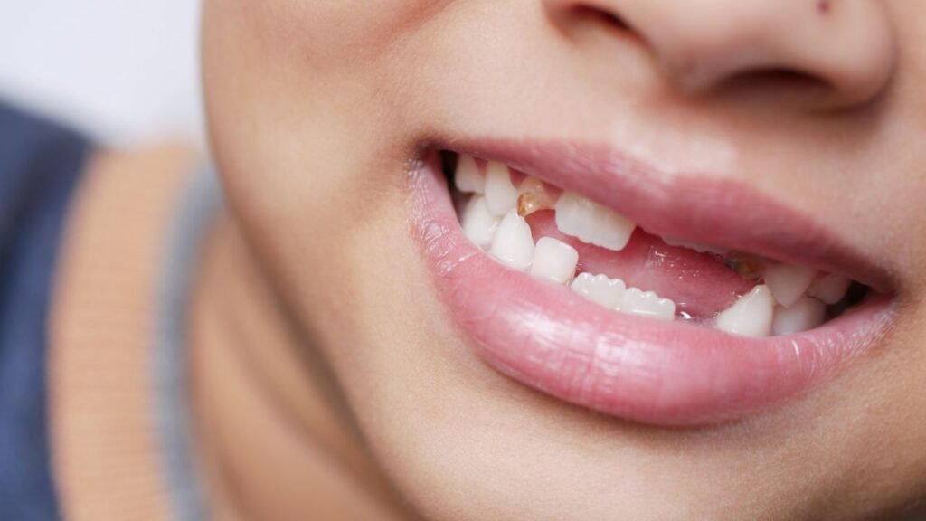 boca infantil de uma criança com os dentes prestes a ficar podre