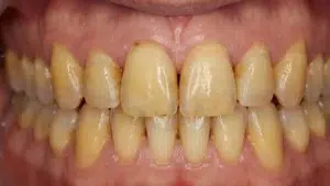 dentes amarelados de um paciente