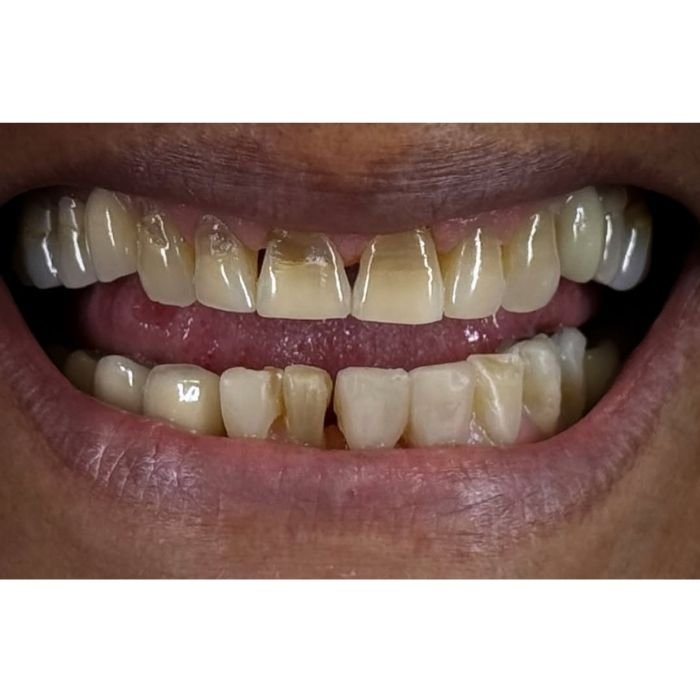 boca da paciente antes de colocar lentes de resina nos dentes