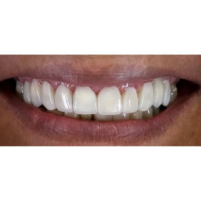 Depois das facetas de resina