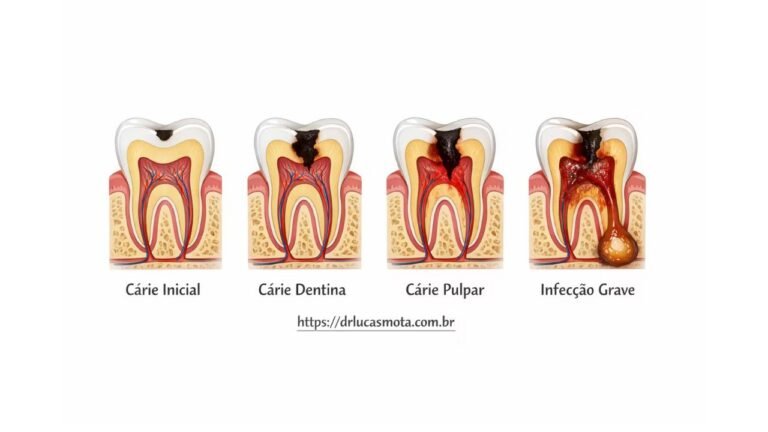 processo de como fica os dentes a cada vez que a cárie vai ficando profunda