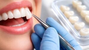 faceta de resina sendo colocada na boca de uma paciente