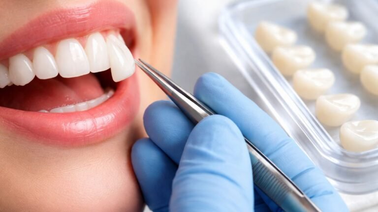 faceta de resina sendo colocada na boca de uma paciente