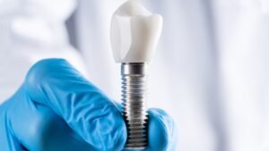 profissional dentista em camaçari segurando um dente de implante dentário em um paciente
